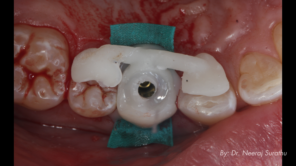 3D printed shell provisional with intraoral chairside pick up in patients mouth