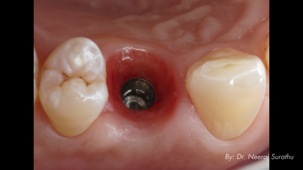 Picture that shows how well the soft tissue maturation is going for a patient after using an immediate provisional in #5 (First bicuspid/premolar) for 3 months