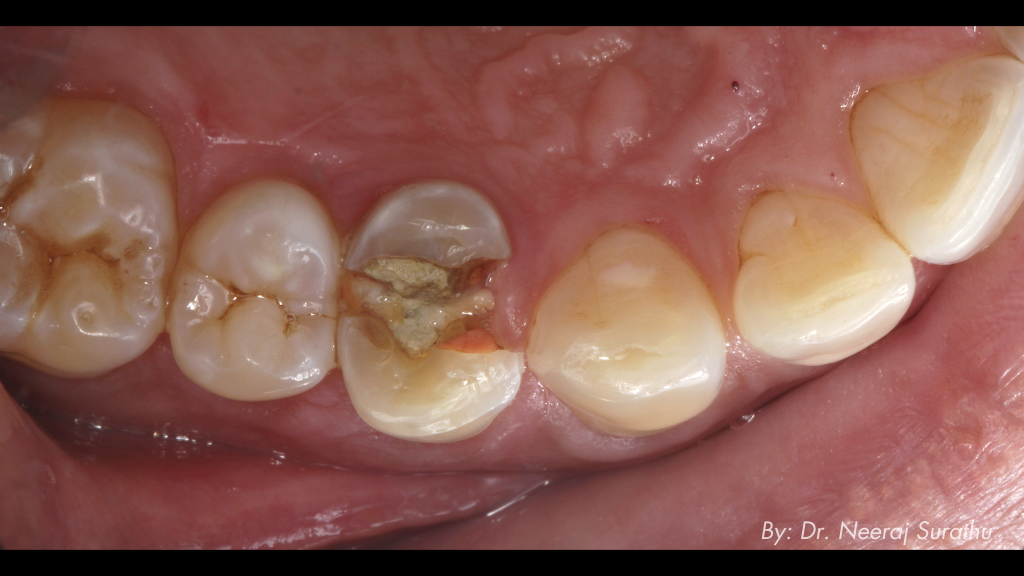 Image of a Fractured #5 (First bicuspid/premolar)