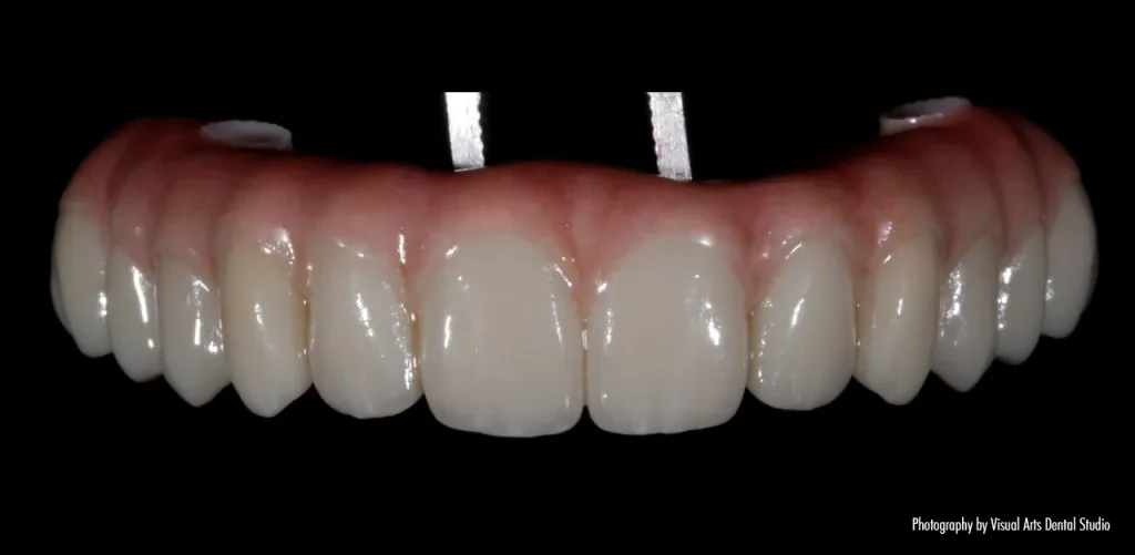 Polished 3D printed All-on-X Implant using RS VIVO resins