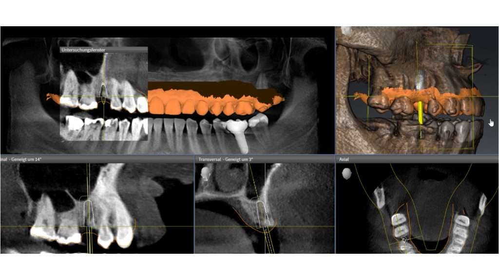 Planificación virtual de implantes asistida por IA en el software SICAT