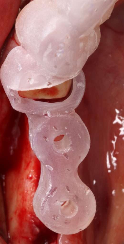 Guía quirúrgica impresa en 3D y guiada por piloto in situ