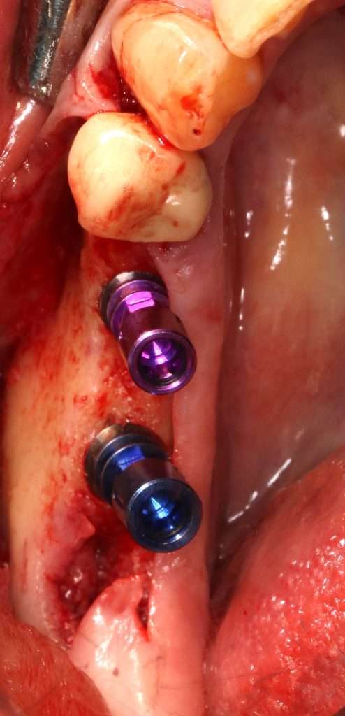 Posiciones de los implantes según el plan de implantes digital, vista oclusal