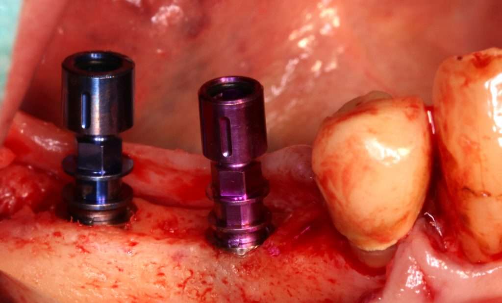 Posiciones de los implantes según el plan de implantes digital, vista lateral