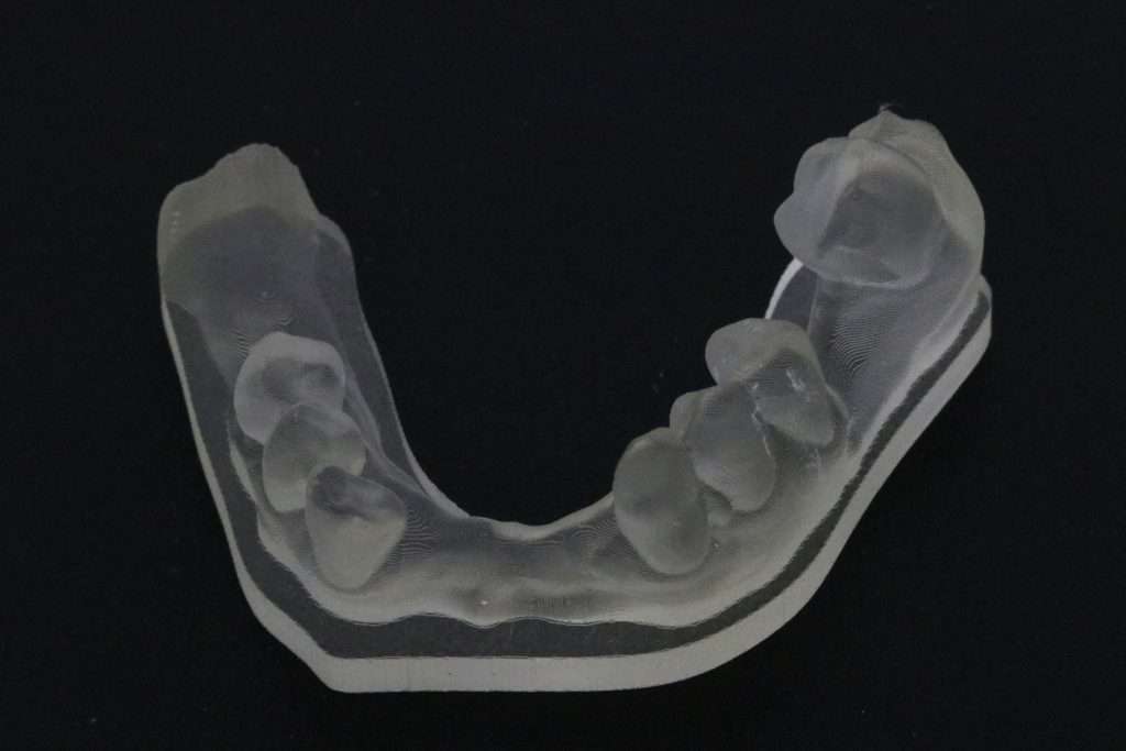 Modelo anatómico impreso en 3D para la evaluación preoperatoria de un defecto de la cresta alveolar