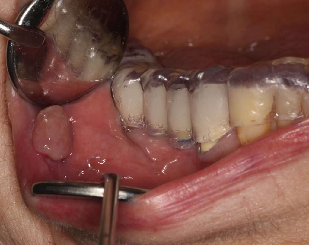 Férula oclusal personalizada impresa en 3D para eliminar la irritación mecánica local en un fibroma irritativo recurrente